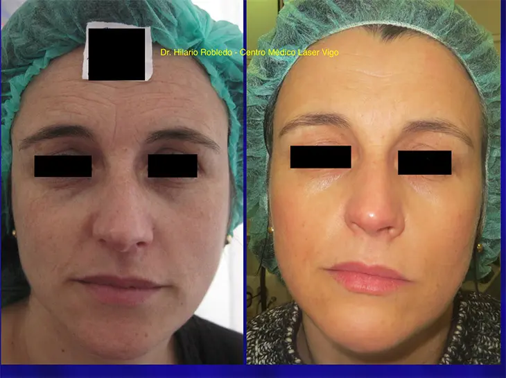 rejuvenecimiento facial 3 laser